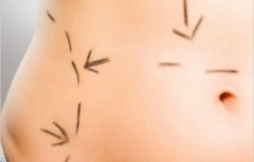 How much fat can be removed by liposuction
